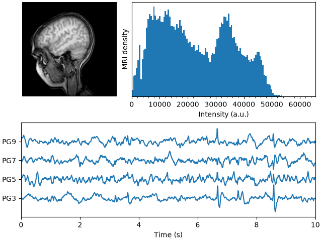 mri with eeg