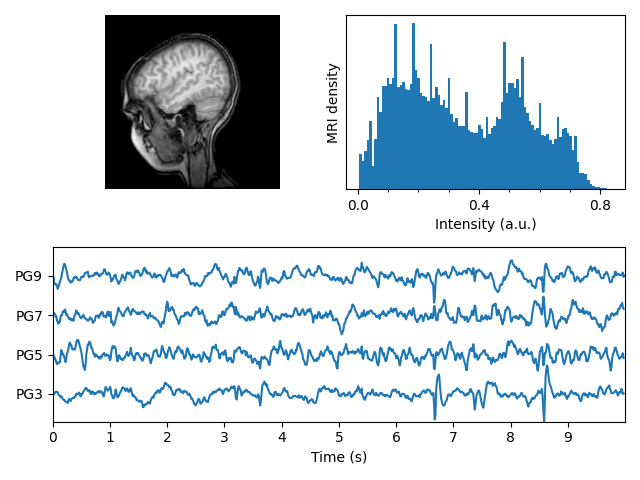 ../../_images/sphx_glr_mri_with_eeg_001.png